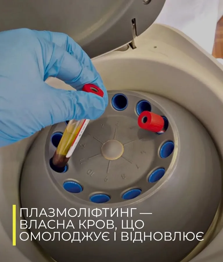 ПЛАЗМОЛІФТИНГ - ВЛАСНА КРОВ, ЩО ОМОЛОЖУЄ
